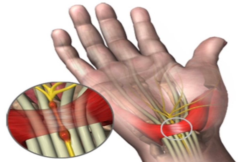 Tunnel Carpale Intervento O Infiltrazioni Cura Nervo Mediano Steroidi